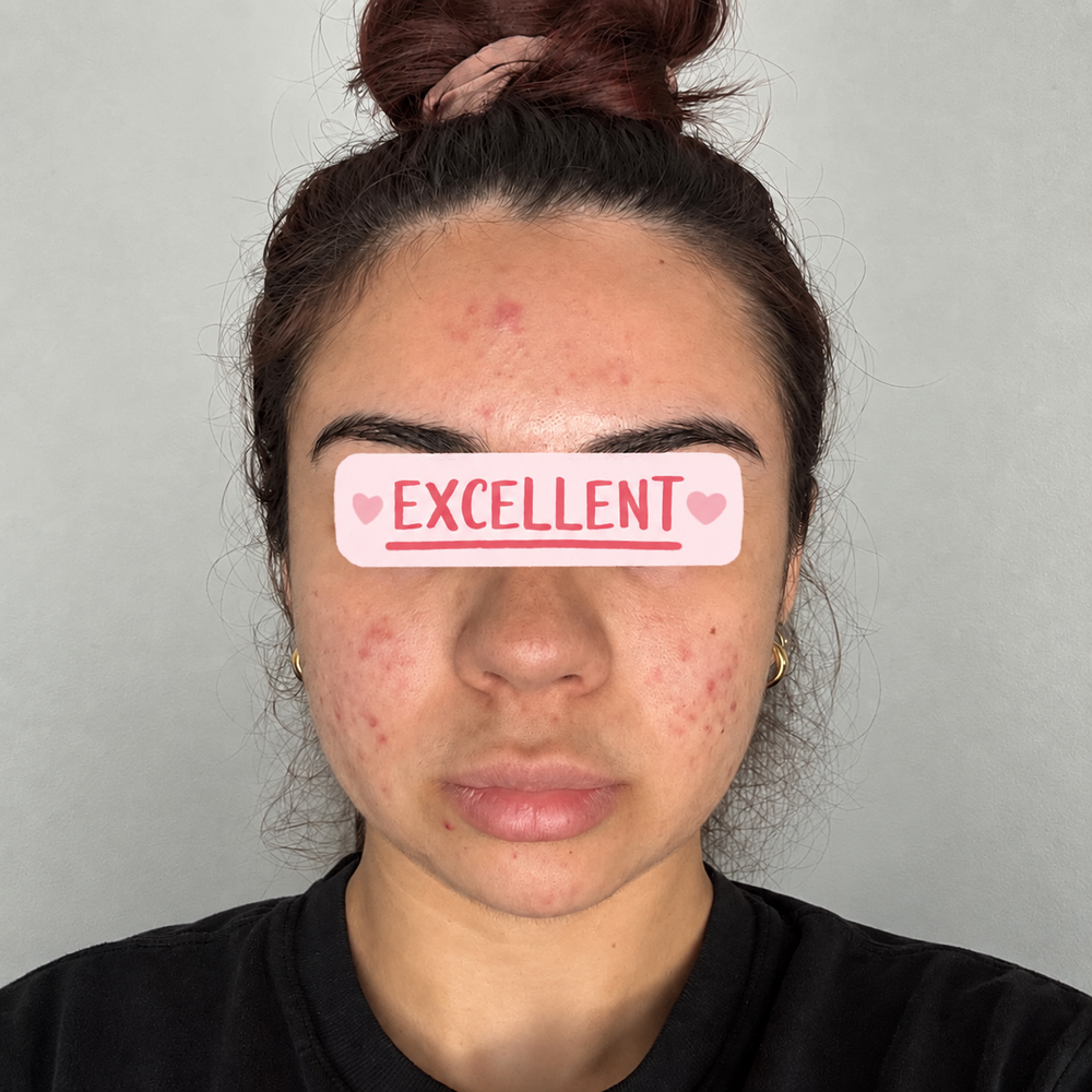 Client skin progress after personalized acne care