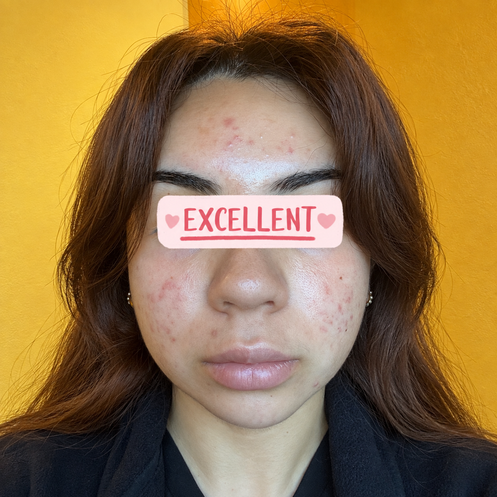 Client skin before personalized acne care