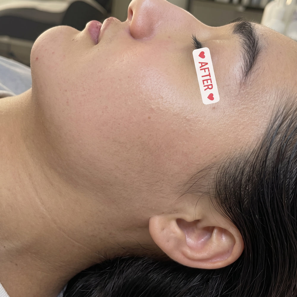 Client skin before personalized acne care