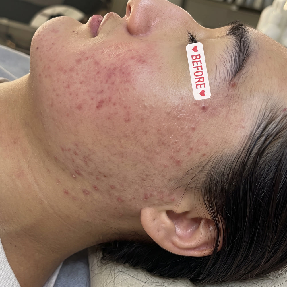 Client skin progress after personalized acne care